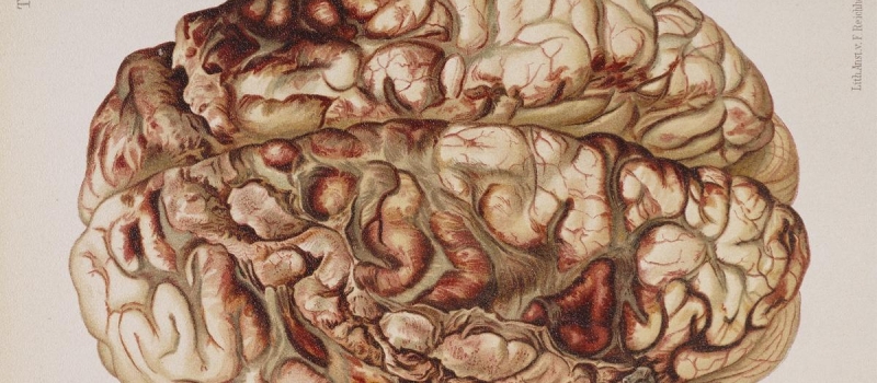 Brain Gunshot Brain Gunshot